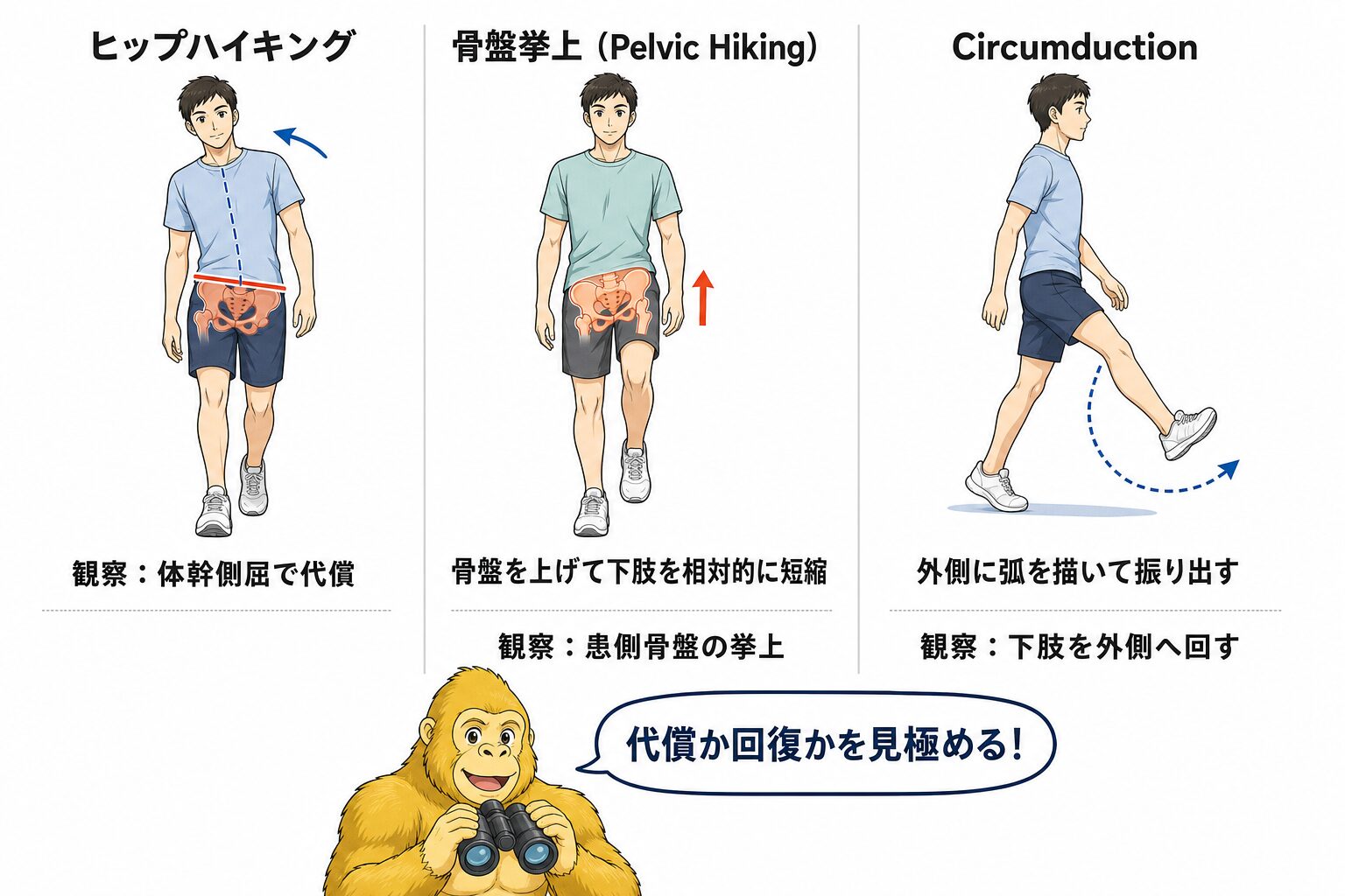代償パターンの観察：ヒップハイキング・circumductionの見方