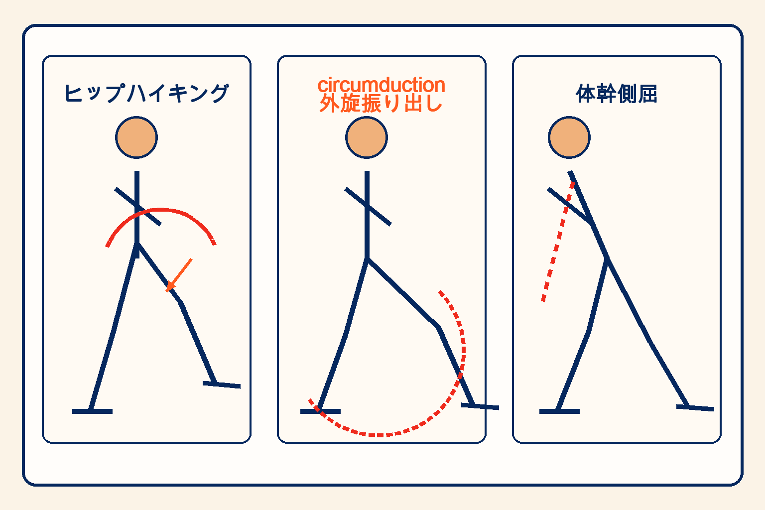 代償パターンの観察：ヒップハイキング・circumductionの見方