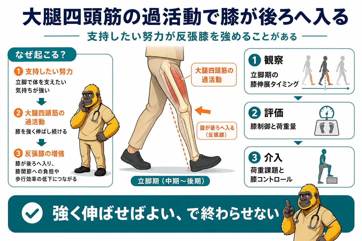 大腿四頭筋の痙縮・過活動と反張膝
